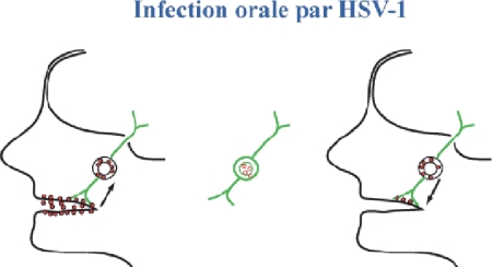 Physiopathologie des infections orales par HSV-1.