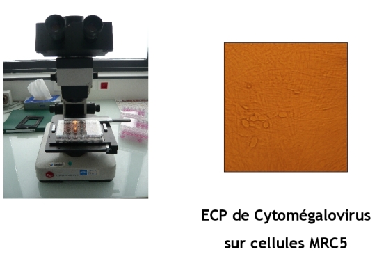 Effet cytopathogène de cytomégalovirus sur cellules MRC5