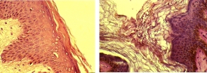 Peau saine (à gauche) - Peau malade (à droite)